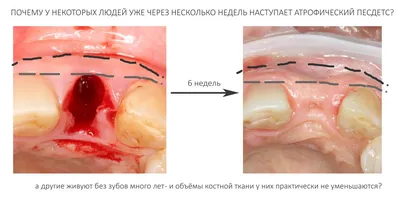 Костная пластика при имплантации зубов - Cтоматология Май