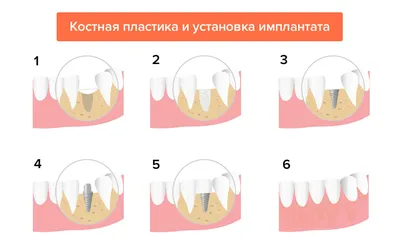 Восстановление костной ткани челюсти в стоматологии