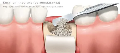 Костная пластика для имплантации зубов [цена в стоматологии Имплантмастер]