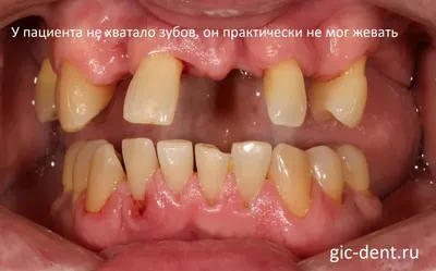 НКР. Направленная костная регенерация и имплантация зубов в Харькове