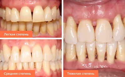 Костная пластика зубов Киев, Бровары - наращивание костной ткани