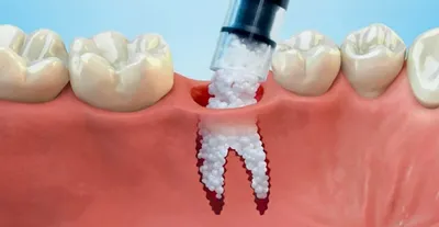 Атрофия костной ткани – главное осложнение после удаления зуба - YouTube