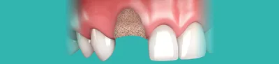 Восстановление костной ткани челюсти в стоматологии