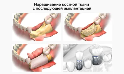 Как уменьшается челюстная кость и что с этим делать? | НК Клиник