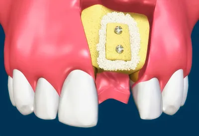 Костная пластика в стоматологии (при имплантации) – цена, отзывы