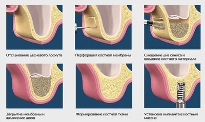 Костная пластика перед имплантацией зубов — когда и как делают