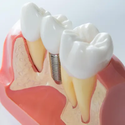 Как разрушаются зубы при сахарном диабете и как их восстановить