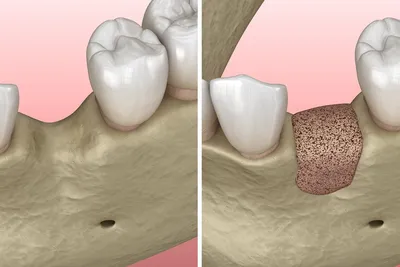 Костная пластика челюстей (зубов): цена при имплантации зубов в  стоматологии Твери