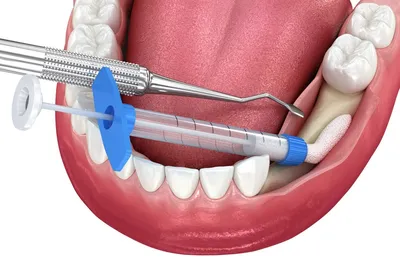 Деструкция костной ткани зуба, исследование очагов инфекции -  DENTALMAGAZINE.RU