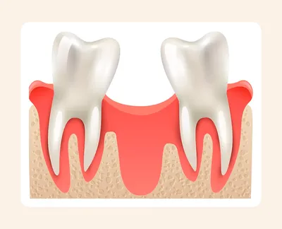Восстановление зубов при почти полной потере костной ткани в верхней  челюсти - работа врачей НИЦ