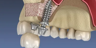 Костная ткань после удаления зуба