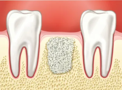 Тотальное восстановление зубов верхней челюсти и множественного отсутствия  зубов на нижней, с реабилитацией временными коронками - Эстетика