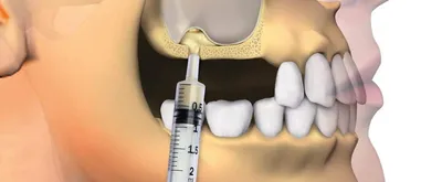 Направленная регенерация костной ткани - Стоматология Москвы \"Королевская  Улыбка\"