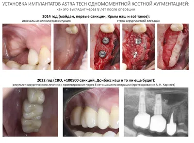 Наращивание костной ткани в стоматологии (остеопластика) - от компании  \"Kornident\"