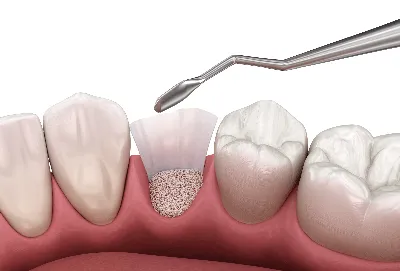 Костная пластика при имплантации зубов в СПб - Стоматологическая клиника  «Галерея Улыбок»