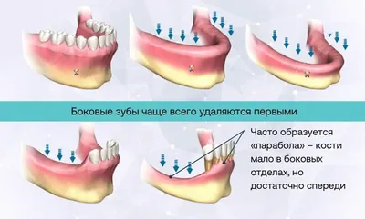 Имплантация при атрофии костной ткани челюсти