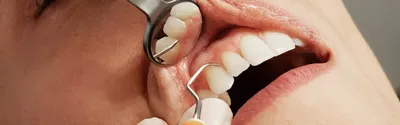 Закрытый синус-лифтинг: увеличение объема костной ткани для имплантатов  зубов