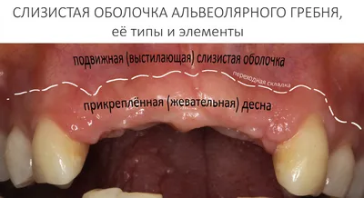 Имплантация зубов с ортодонтической подготовкой и тотальное протезирование  зубов керамикой