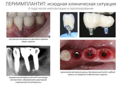 Экзостоз после удаления зуба, выпирает кость что делать?