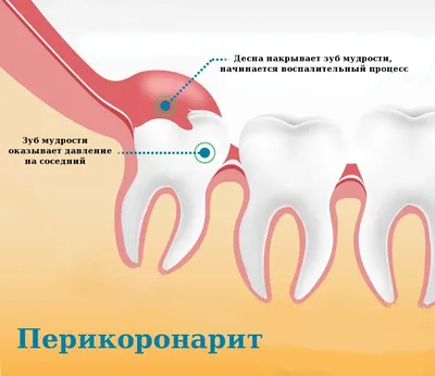 Шишка на десне, что делать? - Полезные статьи на сайте стоматологической  клиники Церекон