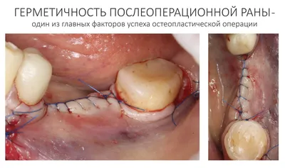 Коллагеновая матрица Fibro-Gide: почему, когда и как? Опыт Клиники ИН,  часть II — CLINICIN.RU