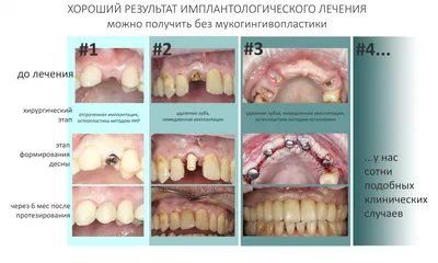 Лечение десен в Москве – цены на лечение воспаленных десен