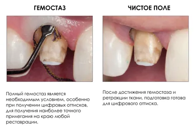 Карман в десне между зубами: 10 признаков того, что необходимо начинать  лечение