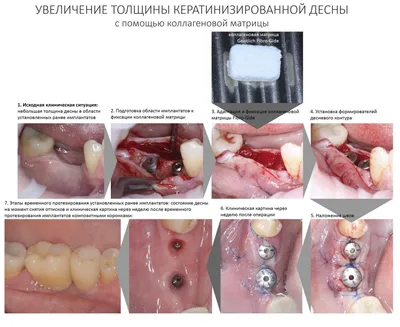 Обнажение имплантата после его установки :: Осложнения при зубной  имплантации