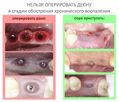 Удаление верхней четверки с одномоментной имплантацией – Немецкий  имплантологический центр, Москва