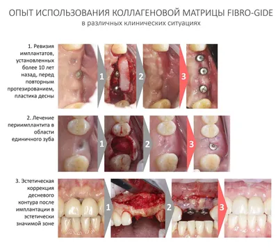 Кюретаж десен (лечение пародонтального кармана) в Кемерово от 2500 рублей