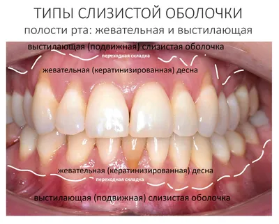 Регенерация десневого сосочка и слизистой оболочки в области промежуточной  части моста