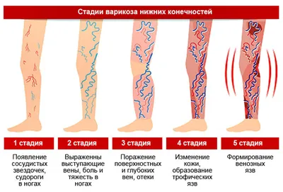 Болезни вен: причины, лечение, последствия · Сосудистый центр им. Т.Топпера