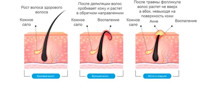 Лазерная или электроэпиляция: что лучше и эффективнее, в чем отличия и  сходства, сравнение лазерной эпиляции и электроэпиляции