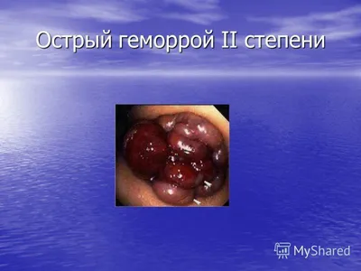 Лечение наружного геморроя - где удалить