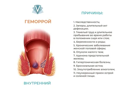 Лечение геморроя лазером в Казани - операция за 10 минут