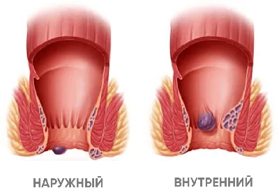 ГЕМОРРОЙ: СИМПТОМЫ, ПРИЧИНА, ЛЕЧЕНИЕ - Kupffer BiothechKupffer