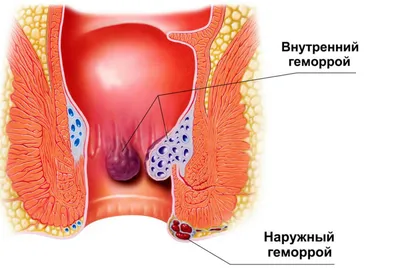 Удаление анальной бахромки лазером в Ужгороде - цена в Украине | Клиника  Биляка