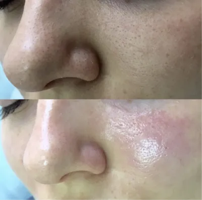 Фото до и после лечения дерматологических заболеваний | Альтермед
