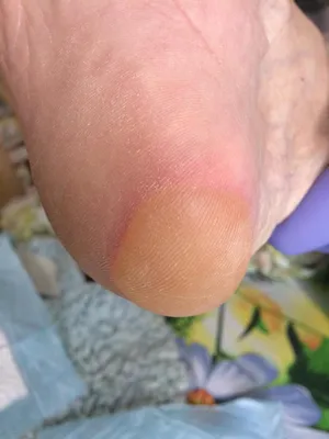 Сыпь на ногах после снятия гипса - Вопрос дерматологу - 03 Онлайн