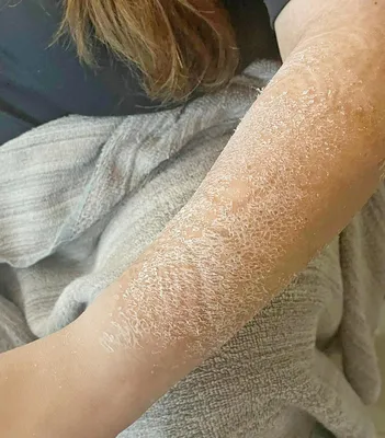 Гипс может вызвать воспаление кожи