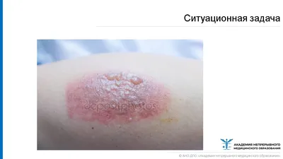 Слез слой кожи: девочка получила ожог после слепка руки в гипсе | Новости –  Gorsite.ru