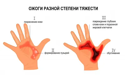 Девушки с ожогами предсказали проблемы Марины Хлебниковой после пожара - МК