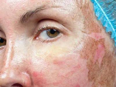 Петербурженка получила некроз кожи лица и ожоги после косметической  процедуры - Газета.Ru | Новости