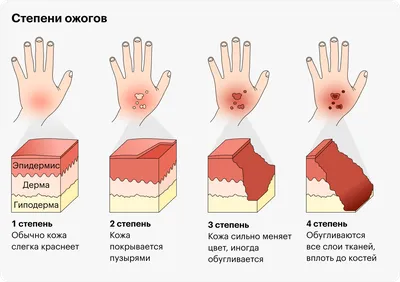 Что делать при ожогах: первая помощь и лечение - Apteka.com