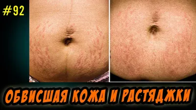 Какие операции нужно сделать после похудения - Cosmetic-clinic