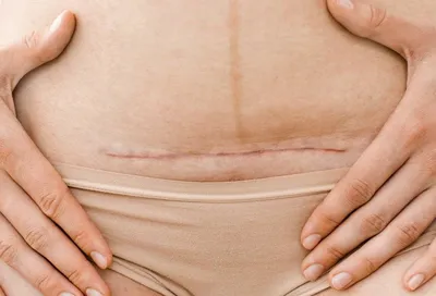 Кожа после похудения: как вернуть ее упругость - Клиника в Уручье