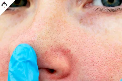 Уход за кожей с куперозом: что делать и как лечить