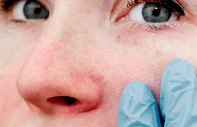 Как избавиться от купероза на лице: эффективные процедуры - Центры эпиляции  и косметологии