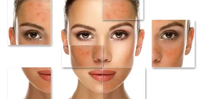 Расширенные поры кожи лица: что делать, как улучшить состояние кожи