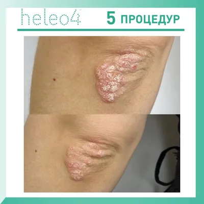 Псориаз - консультация дерматолога онлайн iDerma